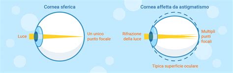 Cos è l astigmatismo Definizione sintomi diagnosi e trattamento