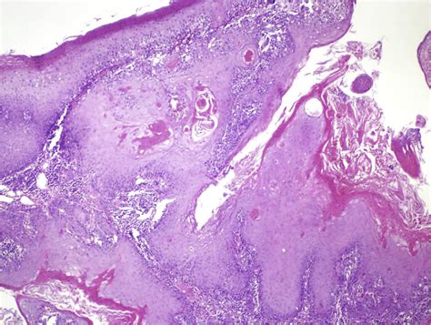 Dermoscopic Features Of Squamous Cell Carcinoma Of The Tongue It Looks