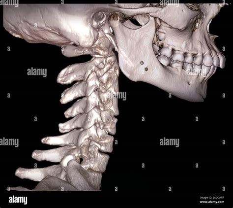 La columna cervical y cráneo 3D tomografía axial computarizada TAC