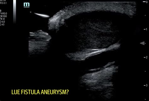 LUE AV Graft Pseudoaneurysm. JETem 2019 - JETem