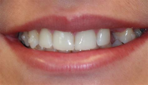 Invisalign With Fake Teeth Added