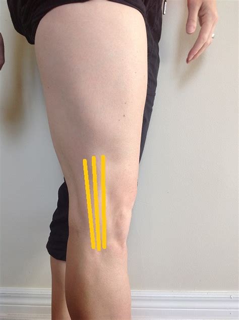 IT Band Syndrome Running Injury Treatment In Burlington ON