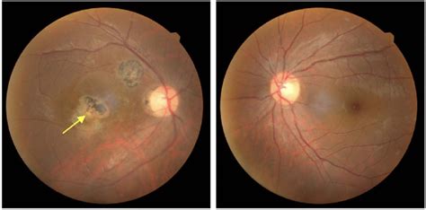 Color Fundus Photograph Of The Second Case Left The Posterior Pole Download Scientific