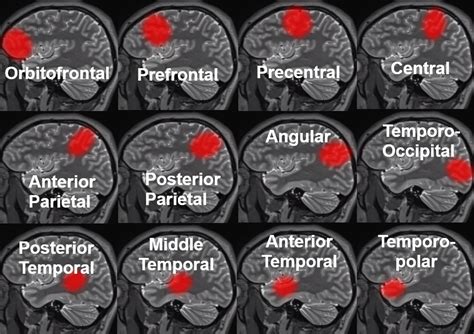 Middle Cerebral Artery