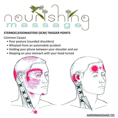 Sternocleidomastoid Trigger Point Release and Stretch - Nourishing Massage