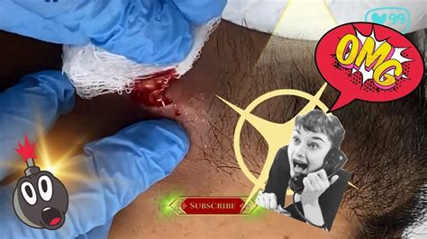 Inflamed Cyst Drainage Drenagem De Cisto Inflamado Cravo Cyst