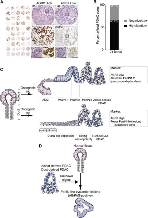 Human PDAC Tumors Show Distinct AGR2 Expression And Model Comparing