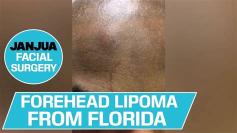 Forehead Lipoma From Florida Dr Tanveer Janjua New Jersey Youtube