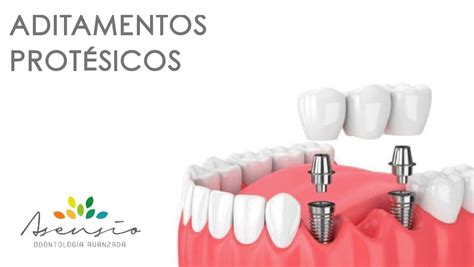 Qu Son Los Aditamentos Prot Sicos Para Implantes Dentales Dental