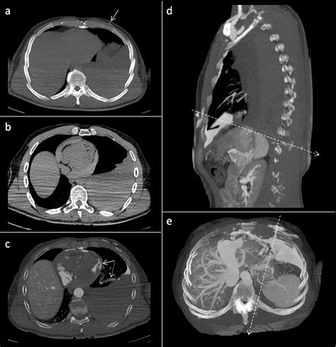 Figure 1 From Advances In Post Mortem CT Angiography Semantic Scholar