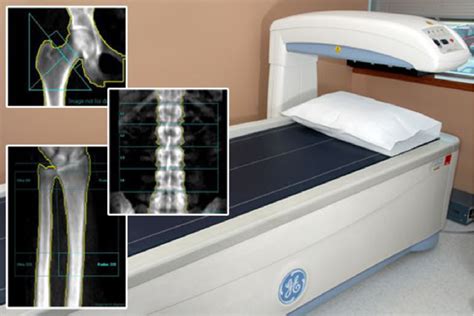 Figure From Dual Energy X Ray Absorptiometry Dexa Or Frax To