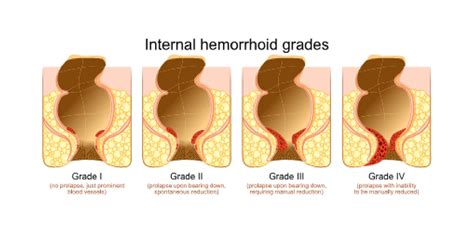 Hemorrhoid Treatment Dr Farah Beshoy