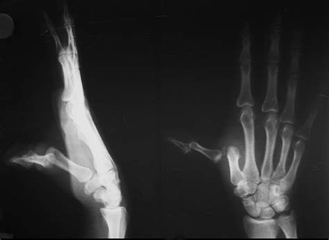 Showing Dislocation of MCP and IP Joints in Thumb | Download Scientific ...