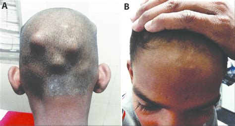 Subcutaneous Nodules Rheumatic Fever