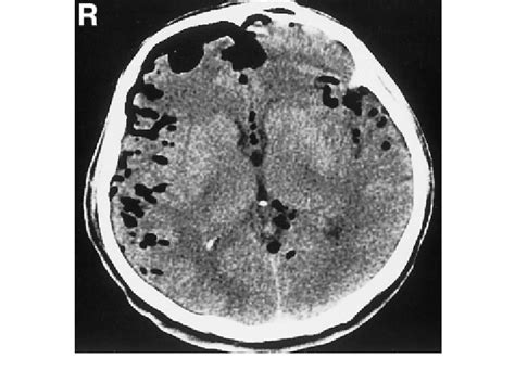 Computed Tomography Scan Showing Severe Pneumocephalus Following A