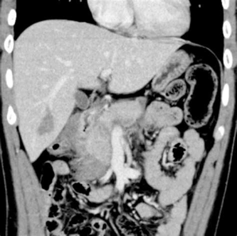 Combination Therapy With Early Nasopancreatic Drainage And Minimum Surgery For Blunt High‐grade