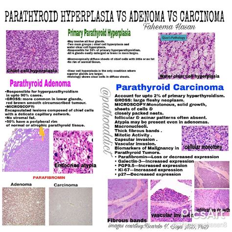 Parathyroid Adenoma Histology