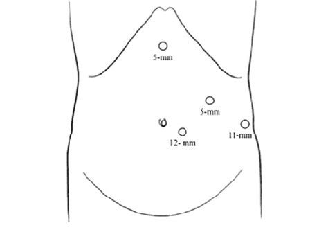 Port Placement For Laparoscopic Distal Pancreatectomy Four Ports