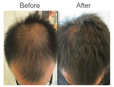 HairSmart laser hair growth cap - PRP Science MD