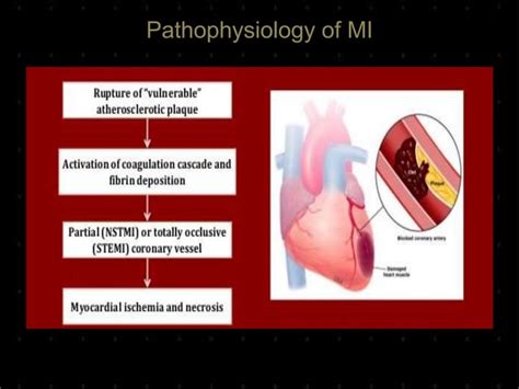 Myocardial Infarction Ppt