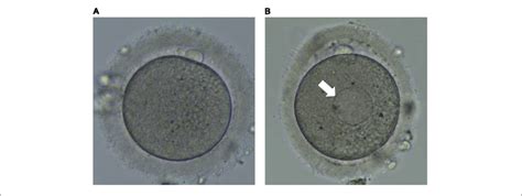 Human Metaphase Ii Oocytes As Viewed By Light Microscopy A Normal Download Scientific