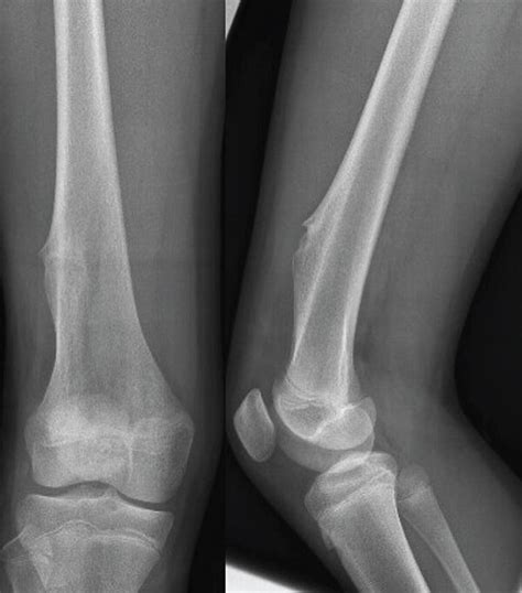 AP And Lateral Plain Radiographs Of The Right Distal Femur Demonstrate