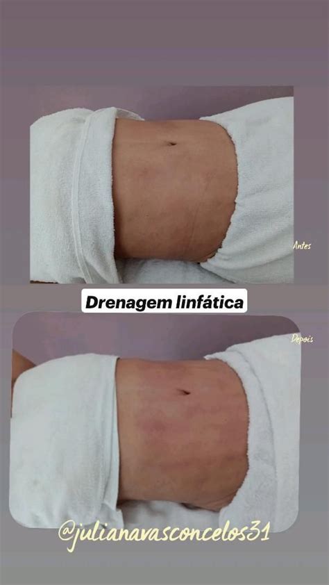 Drenagem Linf Tica Julianavasconcelos Antes Depois