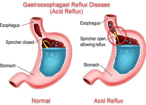 reflux bedeutung refluxkrankheit ursachen symptome therapie lqrvsa