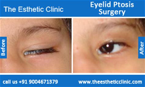 Treatment For Drooping Eyelids Ptosis Eyelid Surgery India Dr