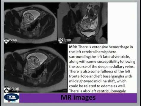 Fetal Intracranial Hemorrhage Birth Injury