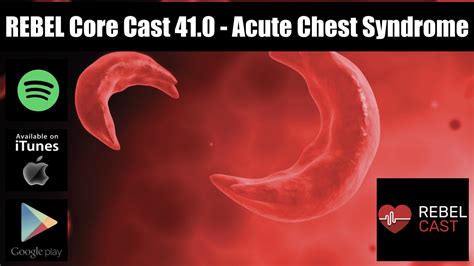 REBEL Core Cast 41 0 Acute Chest Syndrome REBEL EM Emergency