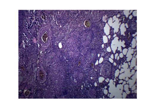 Tuberculosis Lungs Histology