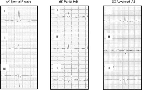 -P wave patterns. (A) Normal P wave: P wave
