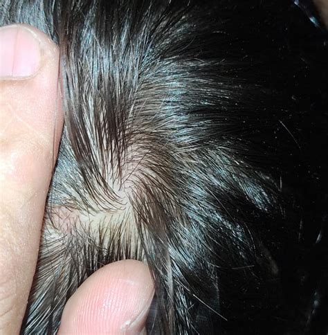 I have these 3 spots in my scalp since 3 years. They produce dandruff ...