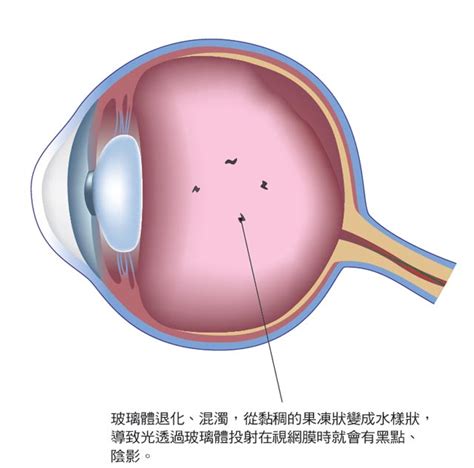 飛蚊症 身體百科 康健雜誌