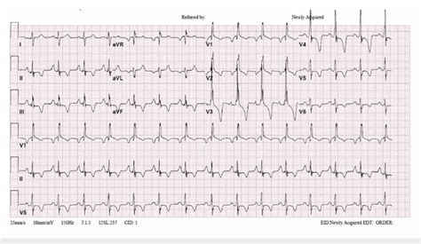 Patients Electrocardiogram Showing Right Bundle Branch Block And Right