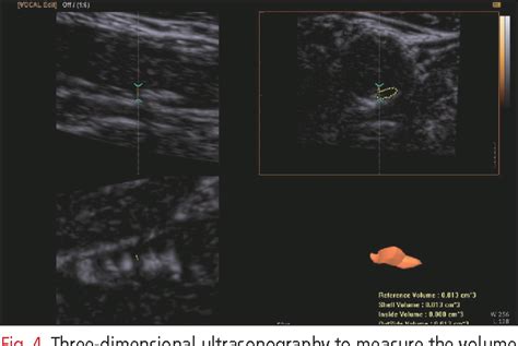 Figure 1 From General Principles Of Carotid Doppler Ultrasonography Semantic Scholar