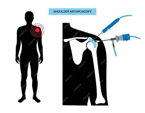 Procedimiento De Artroscopia De Hombro Bursitis Por Descompresión