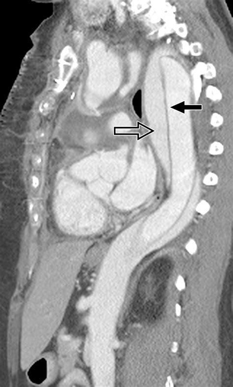 enlarged aorta radiology