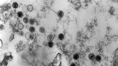 Scientists Debate The Role Of A Virus In Multiple Sclerosis