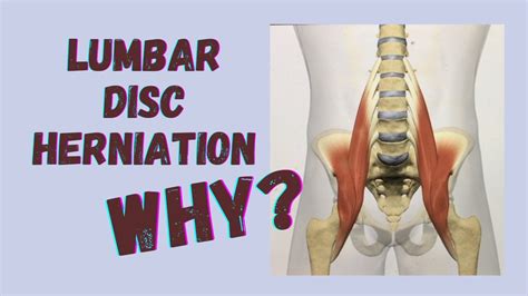 What Causes Lumbar Disc Herniation?