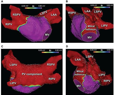 Cryoballoon Ablation Of The Pulmonary Veins The Posterior Wall The