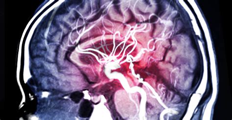 Cisticercosis cuáles son los síntomas de parásitos en el cerebro