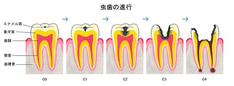 むし歯の進み方