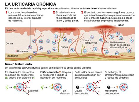 Infográfico Tratamiento Con Omalizumab De La Urticaria Crónica Clínica