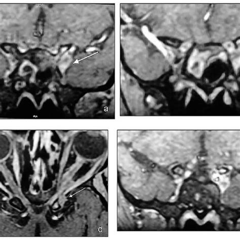 A Contrast Enhanced Magnetic Resonance Imaging MRI Brain And Orbit