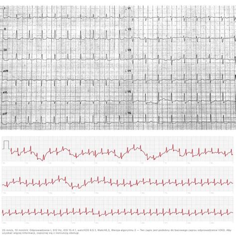 A ECG On Admission To Hospital Sinus Tachycardia 113 Bpm Normal