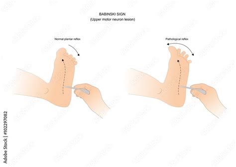 test for a possible motor neuron lesion: the babinski sign Stock Vector ...