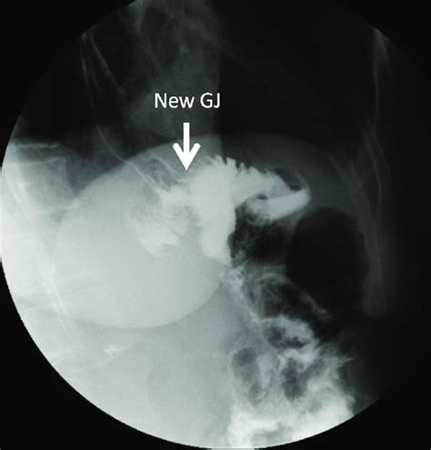 An Upper Gi Series Completed 10 Days After The Procedure Showing