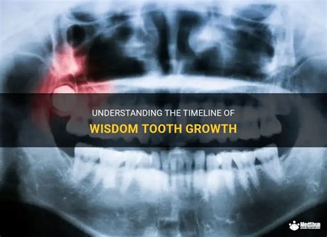 Understanding The Timeline Of Wisdom Tooth Growth | MedShun